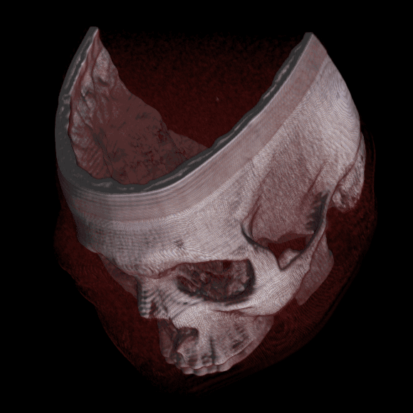 A three-dimensional CT volume rendering of a human head