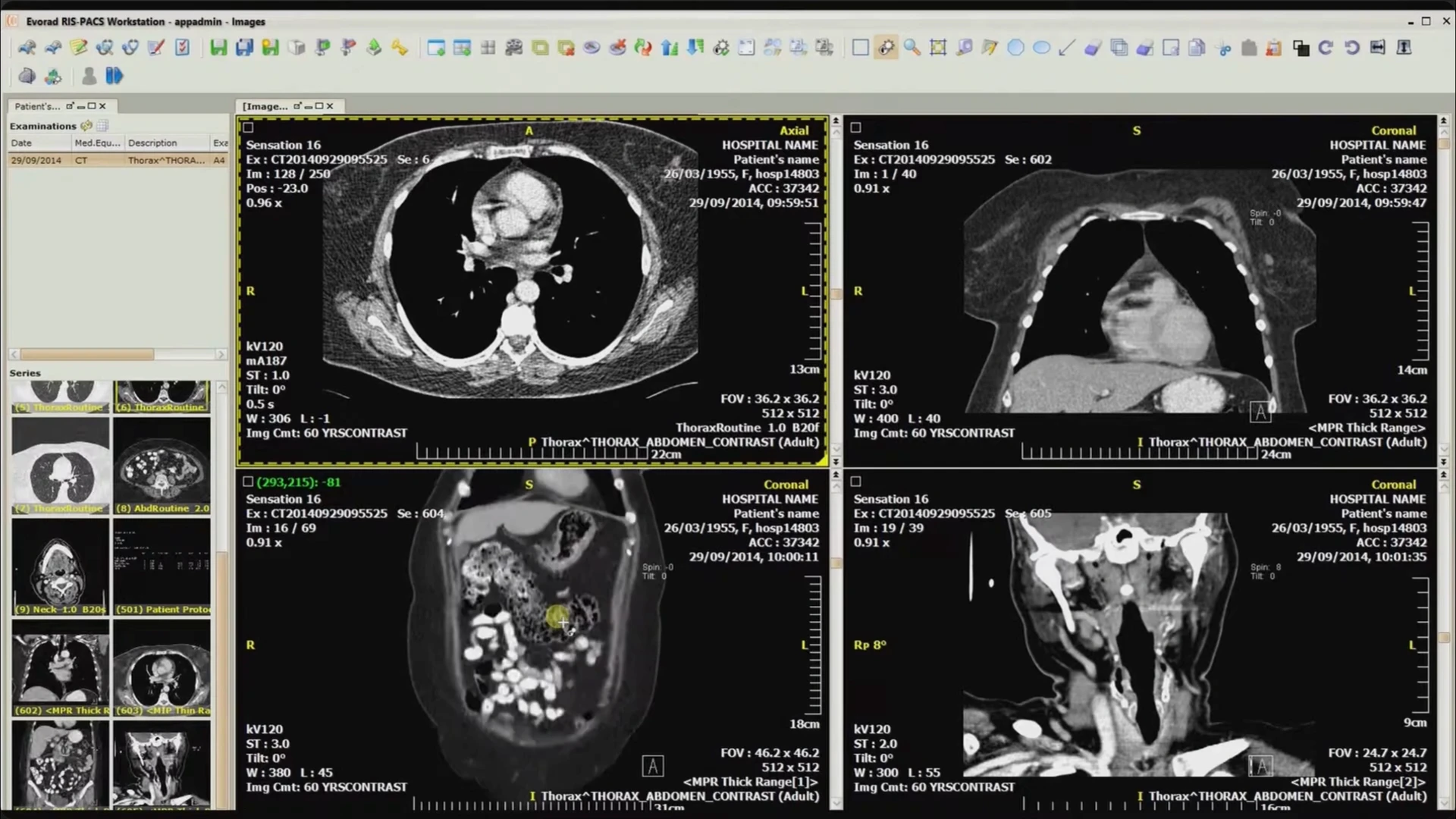 Four CT views open together, with axial and coronal orientations and the series browser at the left.