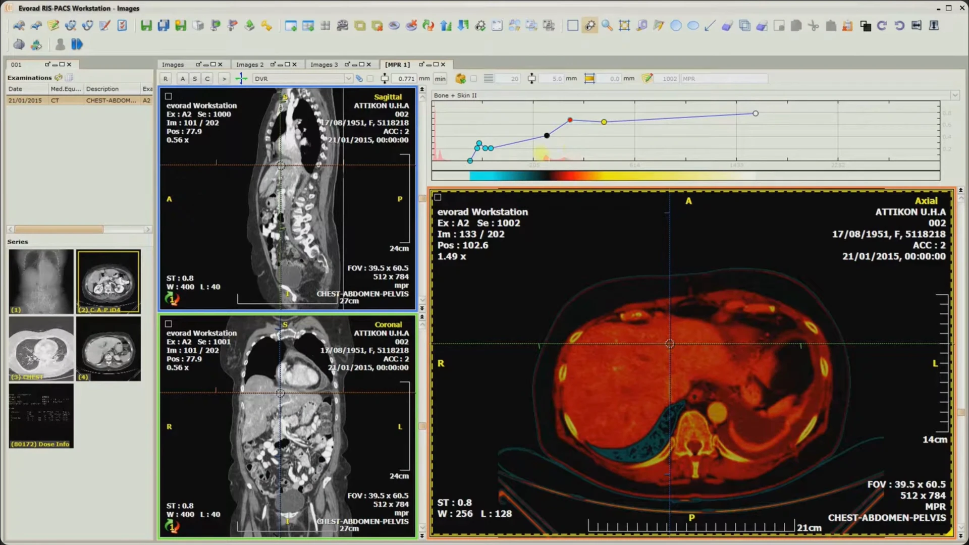 The same reconstruction workspace with an adjusted display curve and changed color presentation of the axial image.