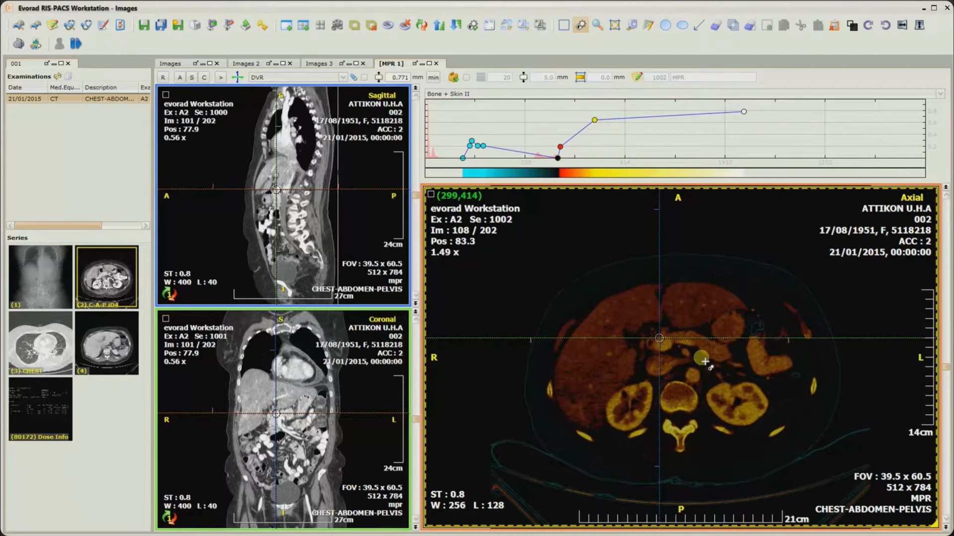 The MPR workspace with a display curve, color scale, and color-mapped axial CT image.