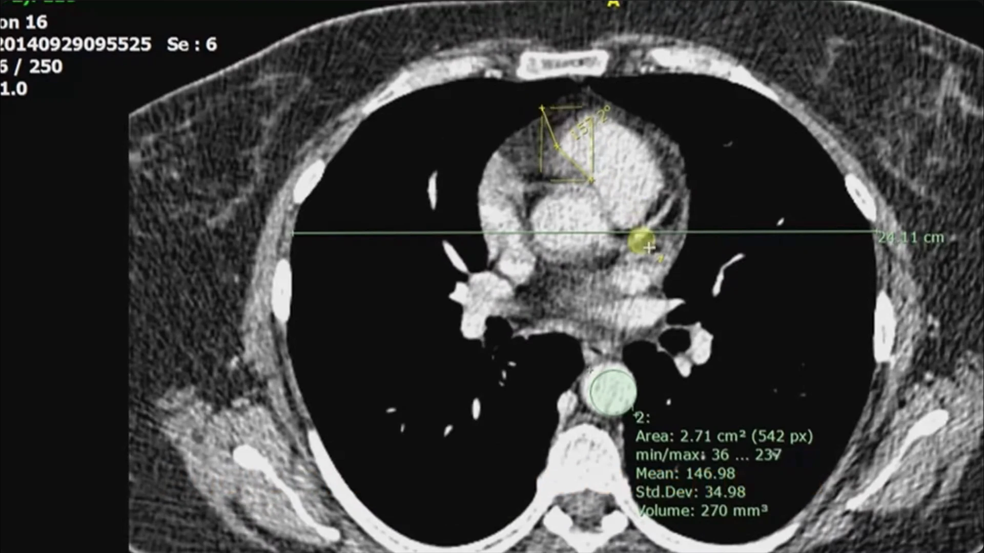 A CT image with a distance line, angle measurement, circular region of interest, and numerical ROI statistics.