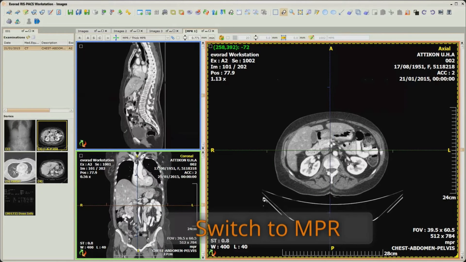 A CT examination in the Evorad MPR workspace with sagittal, coronal, and axial views and intersecting reference lines.